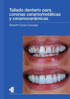 Tallado dentario para coronas ceramometálicas y ceramocerámicas